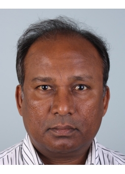 Before Hair Transplant&nbsp;Front